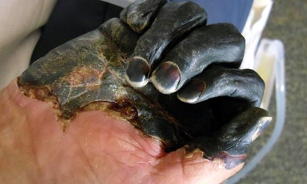 U SAD-u jedan čovjek umro od kuge