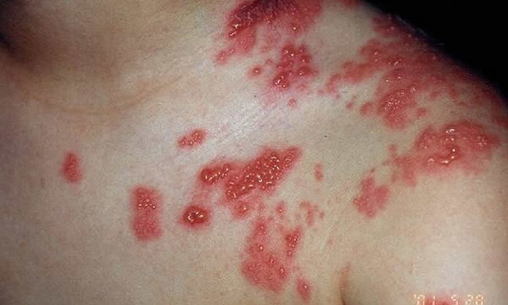 Herpes zoster može da vas pogodi i pri samom kraju života