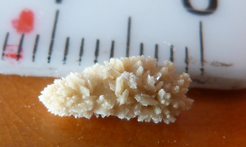 Kako izbaciti kamen iz bubrega?