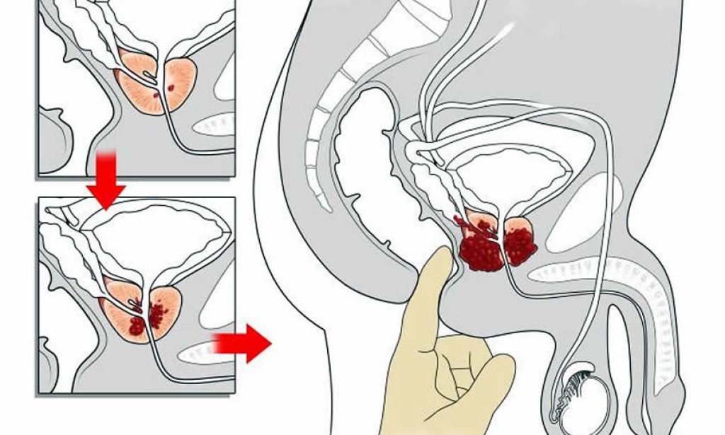 Rak prostate rjeđe pogađa obrezane muškarce
