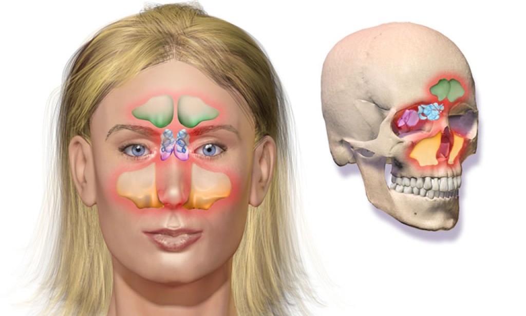 Upala sinusa izazvana prehladom