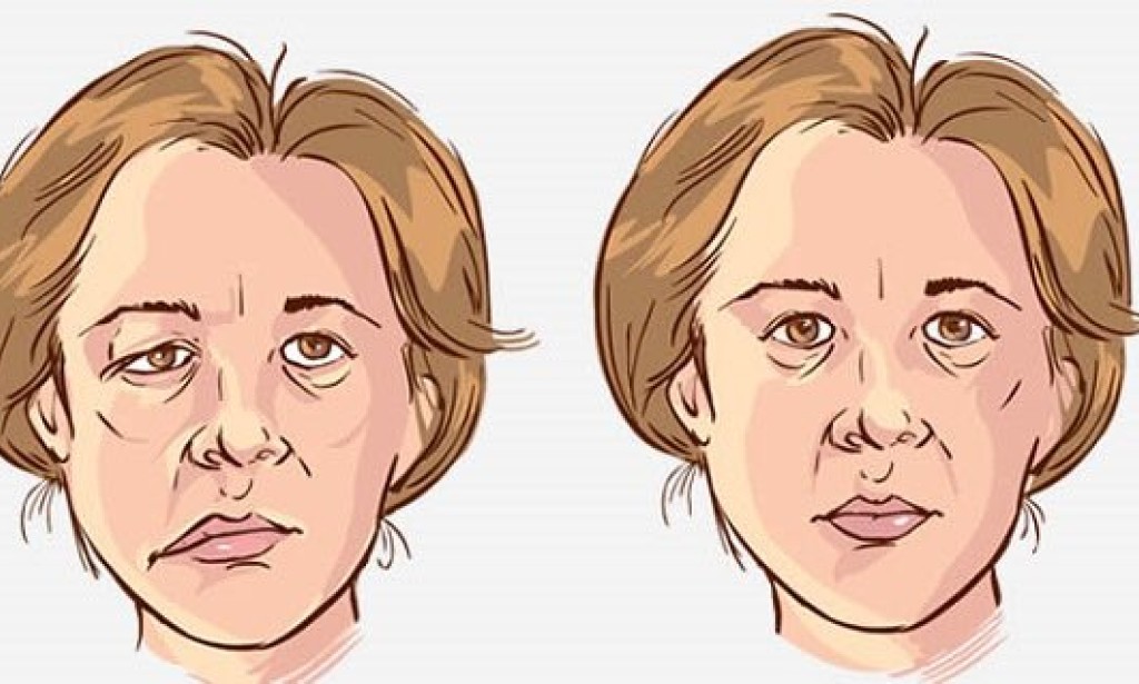 Da li mokra kosa i promaja mogu da izazovu paralizu mišića na licu?