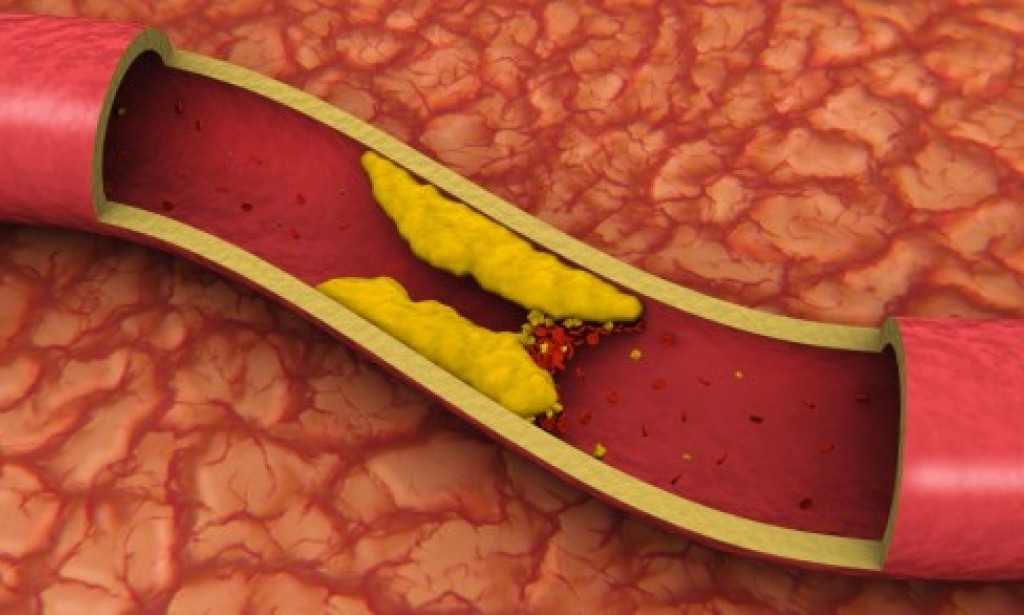 Lijek za holesterol i čišćenje krvnih sudova: Eliksir mladosti