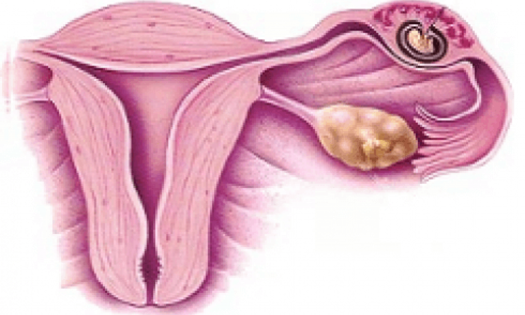 Ektopična trudnoća: Šta je i kako se liječi?