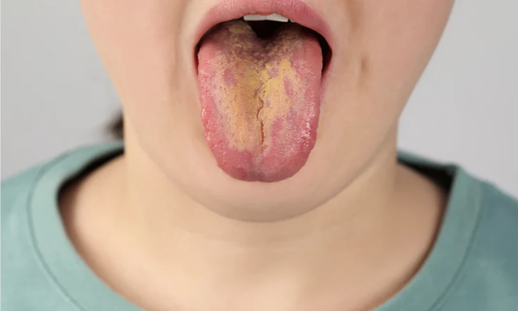 Zašto jezik postaje žut i naučno utemeljeni načini za vraćanje zdravlja